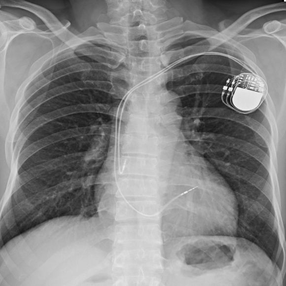 Ein Röntgenbild, das eine Brust mit eingesetztem Herzschrittmacher zeigt.